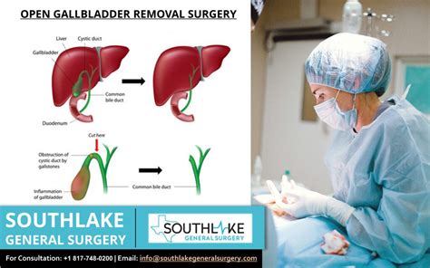 gall gallbladder removal.